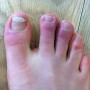 Chilblains on feet