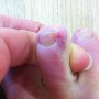 Chilblains on toes